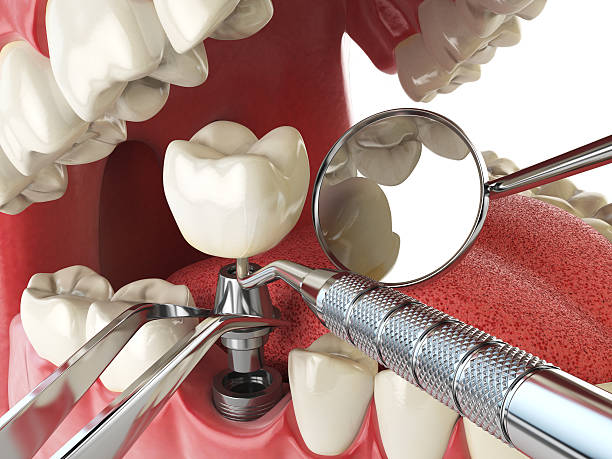 Urgent Tooth Repair in MT